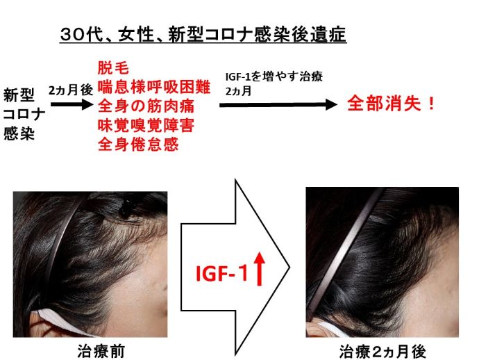 円形脱毛症　病院